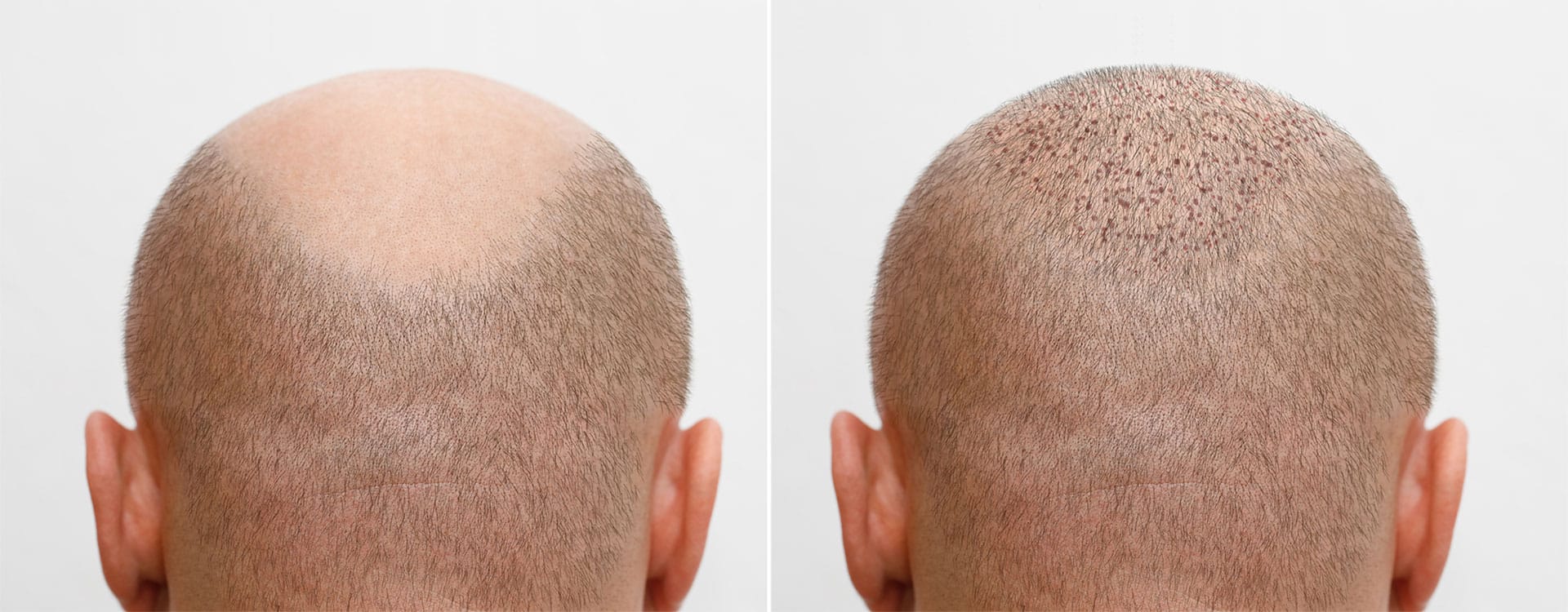 Hair Transplant Treatment