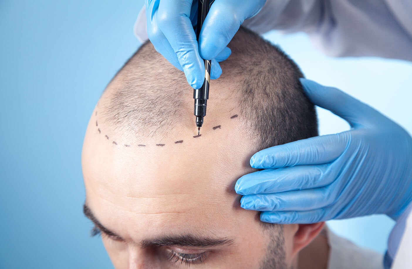 Hair Transplant Process